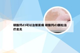 碳酸钙d3可以治银屑病 碳酸钙d3颗粒治疗皮炎