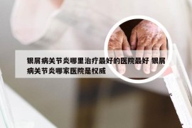 银屑病关节炎哪里治疗最好的医院最好 银屑病关节炎哪家医院是权威