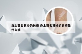 身上莫名其妙的长癣 身上莫名其妙的长癣是什么病