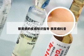 银屑病的疾病知识指导 银屑病科普