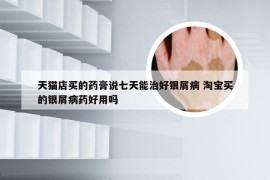 天猫店买的药膏说七天能治好银屑病 淘宝买的银屑病药好用吗