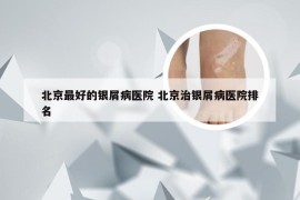 北京最好的银屑病医院 北京治银屑病医院排名