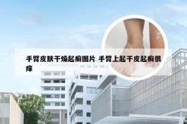 手臂皮肤干燥起癣图片 手臂上起干皮起癣很痒
