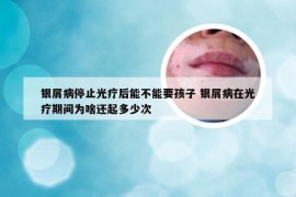 银屑病停止光疗后能不能要孩子 银屑病在光疗期间为啥还起多少次