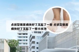 点状型银屑病快好了又起了一些 点状型银屑病快好了又起了一些小水泡
