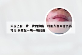 头皮上有一片一片的像癣一样的东西用什么药可治 头皮起一块一块的癣