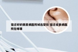 宿迁好的银屑病医院城选楚街 宿迁皮肤病医院在哪里