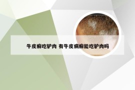 牛皮癣吃驴肉 有牛皮病癣能吃驴肉吗