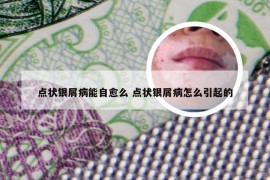 点状银屑病能自愈么 点状银屑病怎么引起的