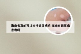 海南省真的可以治疗银屑病吗 海南有银屑病患者吗