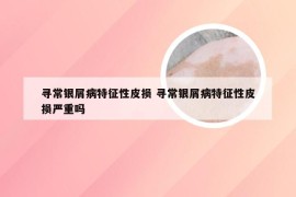 寻常银屑病特征性皮损 寻常银屑病特征性皮损严重吗