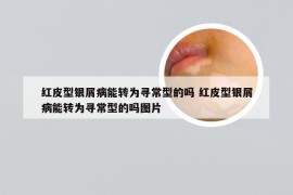 红皮型银屑病能转为寻常型的吗 红皮型银屑病能转为寻常型的吗图片