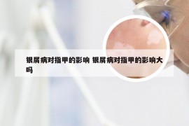 银屑病对指甲的影响 银屑病对指甲的影响大吗