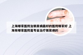 上海哪家医院治银屑病最好的医院哪家好 上海有哪家医院是专业治疗银屑病的