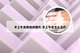 手上牛皮鲜症状图片 手上牛皮怎么治疗