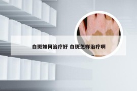 白斑如何治疗好 白斑怎样治疗啊