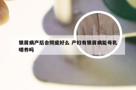 银屑病产后会彻底好么 产妇有银屑病能母乳喂养吗