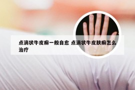 点滴状牛皮癣一般自愈 点滴状牛皮肤癣怎么治疗