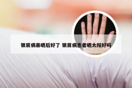 银屑病暴晒后好了 银屑病患者晒太阳好吗