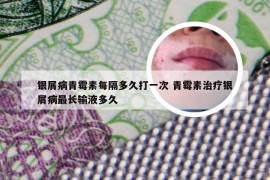银屑病青霉素每隔多久打一次 青霉素治疗银屑病最长输液多久