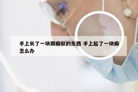 手上长了一块跟癣似的东西 手上起了一块癣怎么办