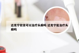达克宁软膏可以治疗头癣吗 达克宁能治疗头癣吗
