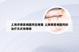 上海市银屑病医院在哪里 上海银屑病医院的治疗方式有哪些