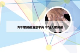 青年银屑病治愈率高 年轻人银屑病