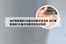 治疗银屑病的5大偏方效果又快又好 治疗银屑病的5大偏方效果又快又好的药