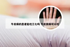 牛皮癣的患者能吃三七吗 牛皮肤癣可以吃