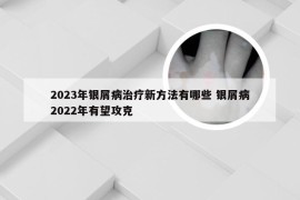 2023年银屑病治疗新方法有哪些 银屑病2022年有望攻克