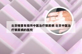 北京哪里有祖传中医治疗银屑病 北京中医治疗银屑病的医院