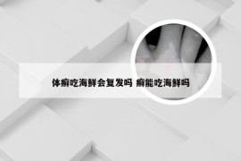 体癣吃海鲜会复发吗 癣能吃海鲜吗