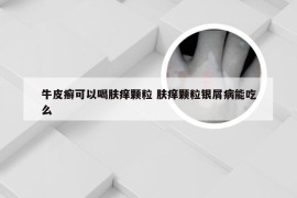 牛皮癣可以喝肤痒颗粒 肤痒颗粒银屑病能吃么