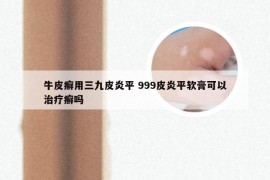 牛皮癣用三九皮炎平 999皮炎平软膏可以治疗癣吗