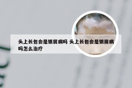 头上长包会是银屑病吗 头上长包会是银屑病吗怎么治疗