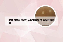 龙华哪里可以治疗头皮银屑病 龙华皮肤病医院