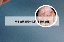 双手皮肤癣用什么药 手部皮肤藓