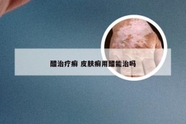 醋治疗癣 皮肤癣用醋能治吗