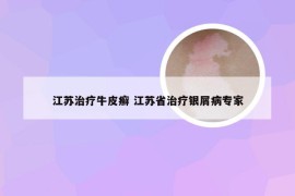 江苏治疗牛皮癣 江苏省治疗银屑病专家