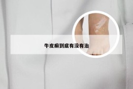 牛皮癣到底有没有治