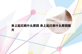 身上起红癣什么原因 身上起红癣什么原因图片