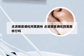点滴银屑病吃阿莫西林 点滴银屑病吃阿莫西林行吗