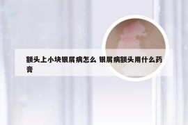 额头上小块银屑病怎么 银屑病额头用什么药膏