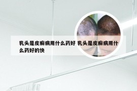 乳头是皮癣病用什么药好 乳头是皮癣病用什么药好的快