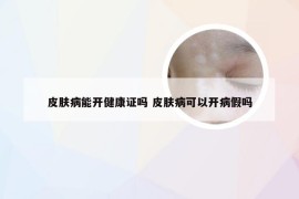 皮肤病能开健康证吗 皮肤病可以开病假吗