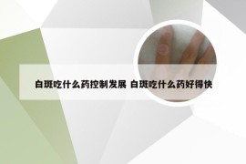 白斑吃什么药控制发展 白斑吃什么药好得快