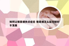 如何让银屑病快点痊愈 银屑病怎么能控制好不发展