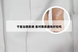 干姜治银屑病 姜对银屑病有好处吗