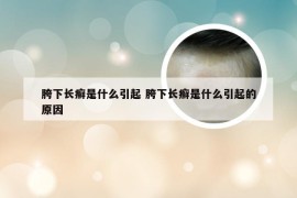 胯下长癣是什么引起 胯下长癣是什么引起的原因